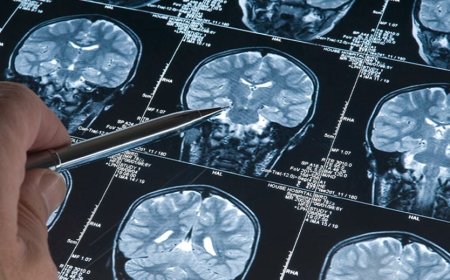 Eski Bir İlacın Alzheimer Bulgularını Geri Çevirdiği Keşfi Bilim Dünyasını Heyecanlandırdı